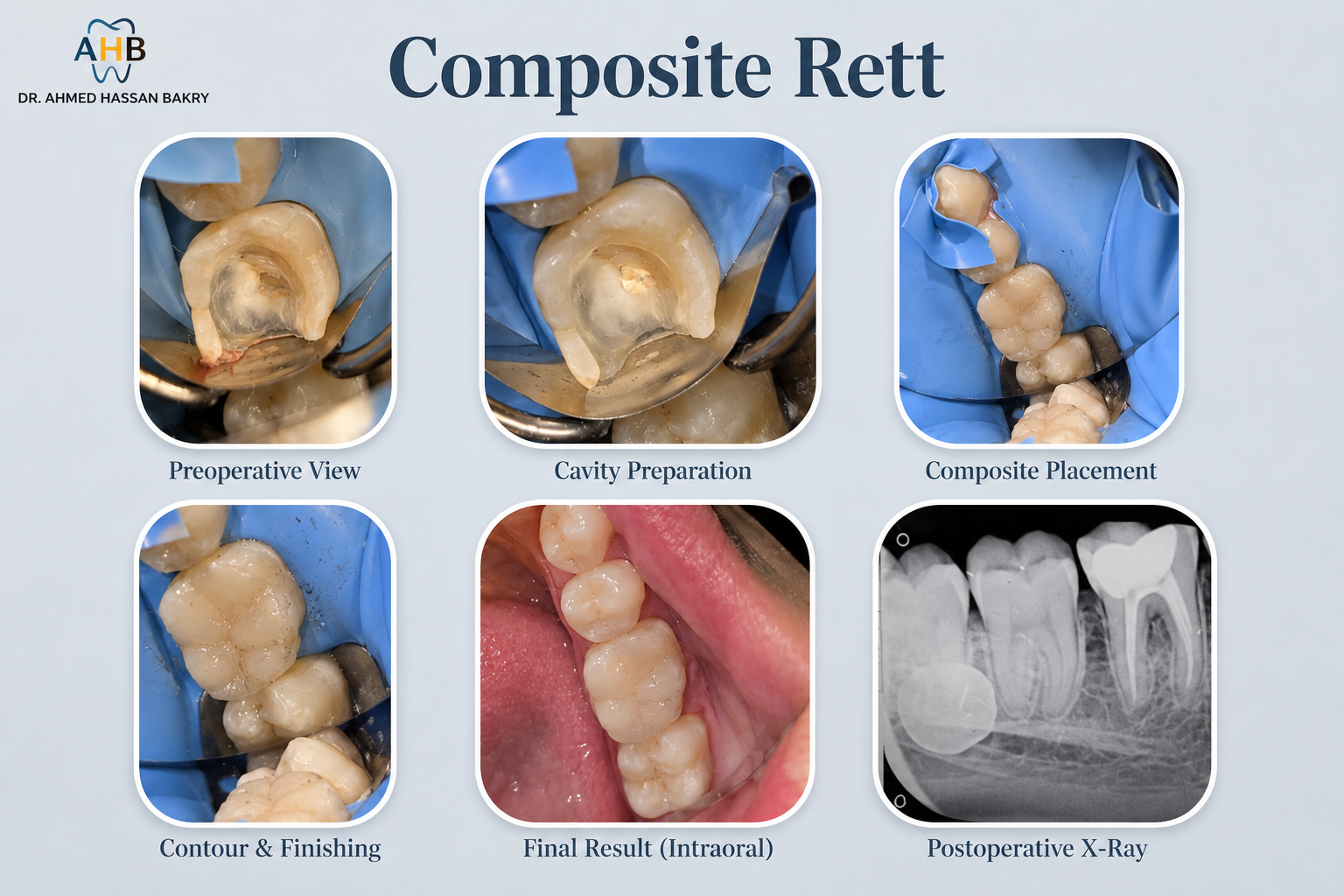 Composite Rett